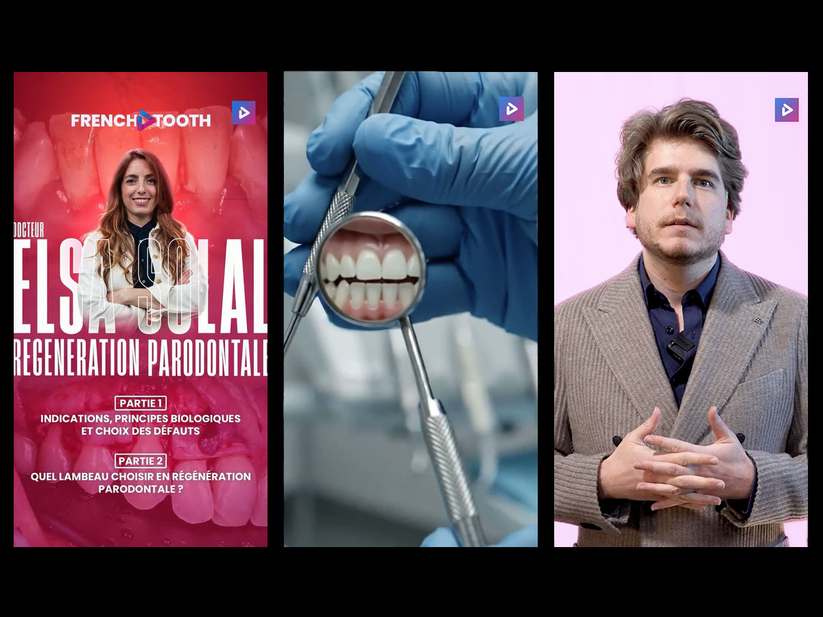 French Tooth